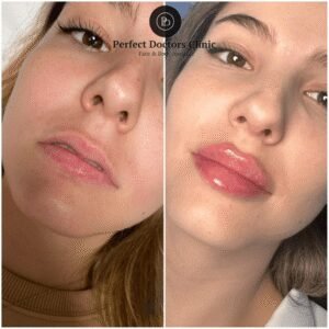 Case studies: Juvederm treatments in Dubai for different ages & ethnicities