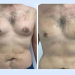 Gynecomastia in Dubai: Long-Term Maintenance Tips