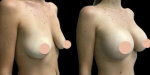 Everything You Should Know About Breast Augmentation in Dubai