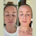 Get Firm, Lifted Skin with Fotona 4D Laser Treatment in Dubai