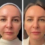 Best Plastic Surgeons in Dubai Mesotherapy for Men’s Skin Rejuvenation