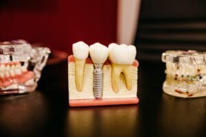 Root Canal Treatment in Panchkula – Cost, Procedure & Results