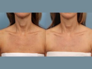 Radiant Results That Last: Moxi Laser Treatment in Dubai