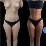 Rejuvenate Your Skin with Advanced J-Plasma Treatment in Dubai