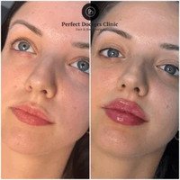 Fillers Treatments in Dubai: FAQs for First-Time Patients