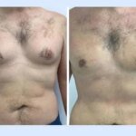 An Inside Look at How the Best Doctors in Dubai Perform Advanced Gynecomastia Procedures