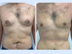 An Inside Look at How the Best Doctors in Dubai Perform Advanced Gynecomastia Procedures