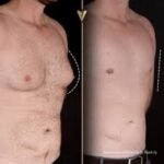 How Much Does Gynecomastia in Dubai Cost? A Complete 2025 Price Guide