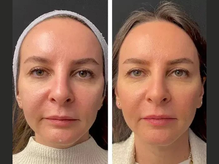 Common Mesotherapy Ingredients and Their Benefits According to the Best Plastic Surgeon in Dubai