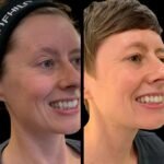 Renew Skin Beauty with Profhilo by the Best Plastic Surgeons in dubai