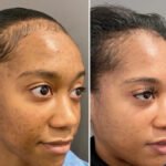 Chemical Peel Safety Tips from the Best Doctors in Dubai You Should Know