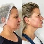 Endolift for Youthful Skin: Expert Advice from the Best Doctors in Dubai