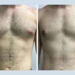 Expert Tips on Recovery from the Best Gynecomastia Surgeons in Dubai