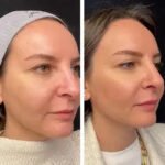 Best Plastic Surgeon in Dubai for Mesotherapy: Lip Hydration & Subtle Plumping