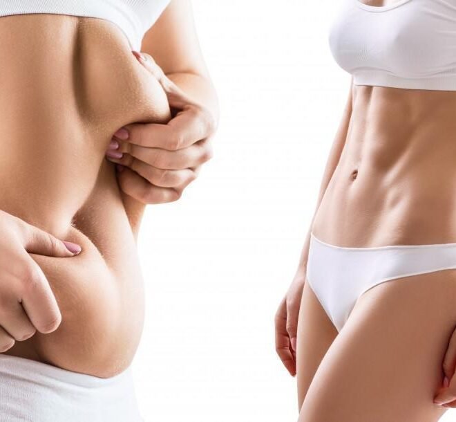What Makes the Best Doctors in Dubai Stand Out in Liposuction Surgery