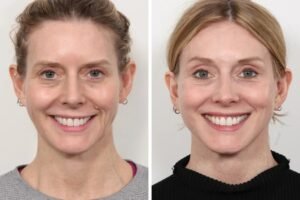 Thread Lift Treatment in Dubai for Natural Lift Results