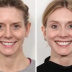 Thread Lift for a Refreshed Look by the Best Plastic Surgeon in Dubai