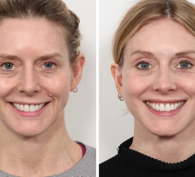 Thread Lift for a Refreshed Look by the Best Plastic Surgeon in Dubai