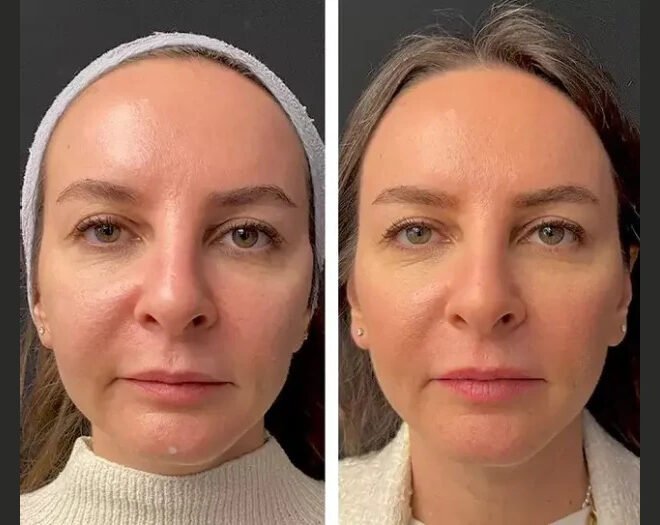 Mesotherapy Treatments in Dubai – Popular Non-Surgical Solutions