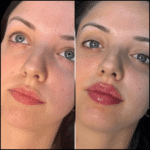 Fillers Treatment in Dubai: Patient Rights and Responsibilities