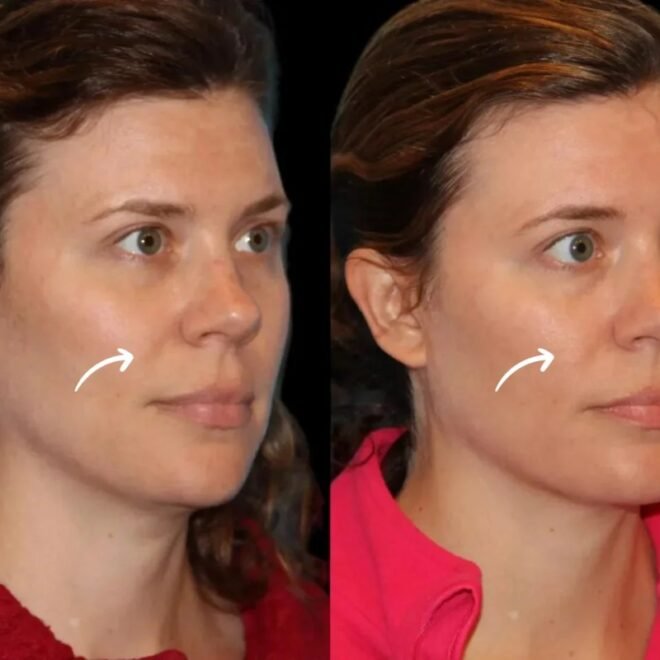 Sculptra Treatment in Dubai Sterility Standards