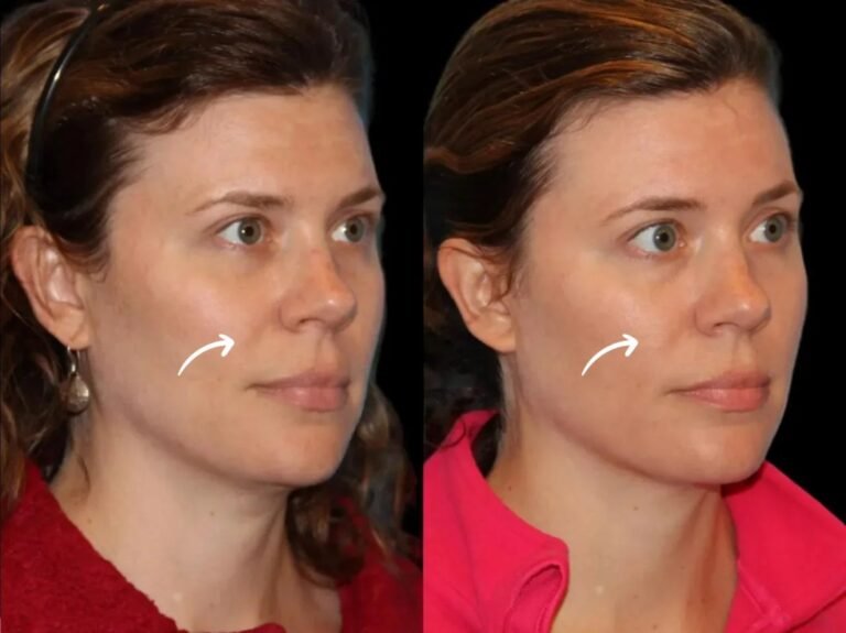 Sculptra Treatment in Dubai Sterility Standards