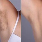 Best Doctors in dubai Offering Painless Laser Hair Removal