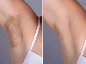Best Doctors in dubai Offering Painless Laser Hair Removal