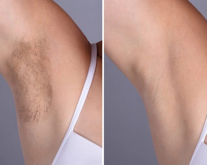 Best Doctors in dubai Offering Painless Laser Hair Removal
