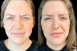 What to Expect When Getting Botox in Dubai: A Complete First-Timer’s Guide