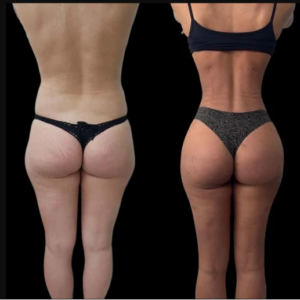 Best Aesthetic Clinic in Dubai for Non-Surgical J-Plasma Skin Rejuvenation