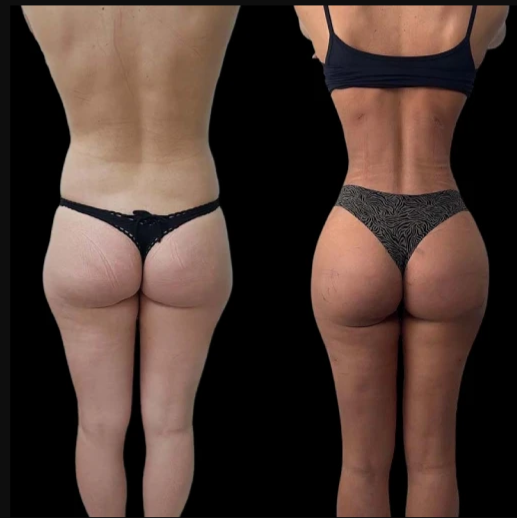 Best Aesthetic Clinic in Dubai for Non-Surgical J-Plasma Skin Rejuvenation