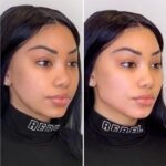 Best Doctors in Dubai for Thread Lift Non-Surgical Facial Youth