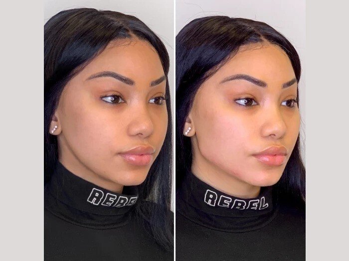 Best Doctors in Dubai for Thread Lift Non-Surgical Facial Youth