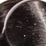 Anti Dandruff Shampoo: The Complete Guide to a Healthy, Flake-Free Scalp