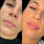 Safe, Smooth, and Stunning: Fillers in Dubai