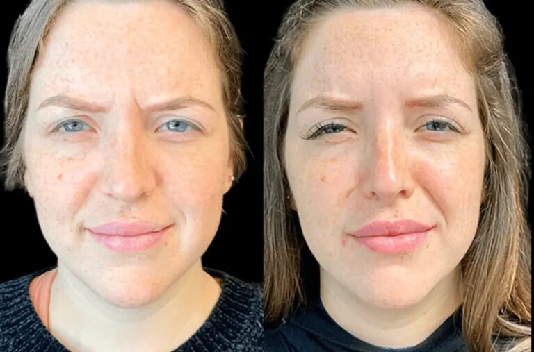 Best Plastic Surgeons in Dubai Share Signs You Need a Botox Touch-Up