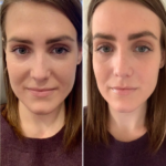 PRP Treatment in Dubai Skin Repair Solution