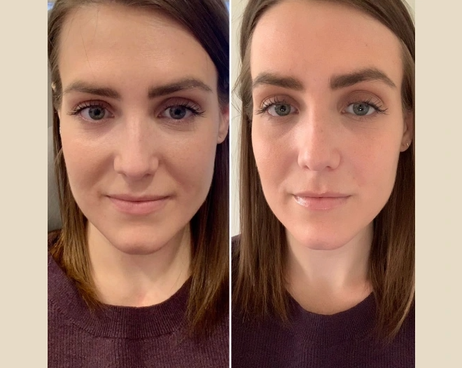 PRP Treatment in Dubai Skin Repair Solution