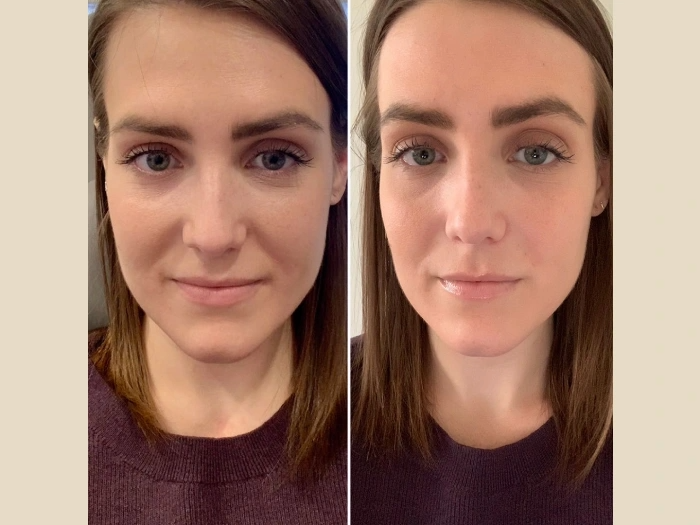 PRP Treatment in Dubai Skin Repair Solution