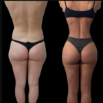 The Science Behind J-Plasma in Dubai and Its Skin Tightening Power