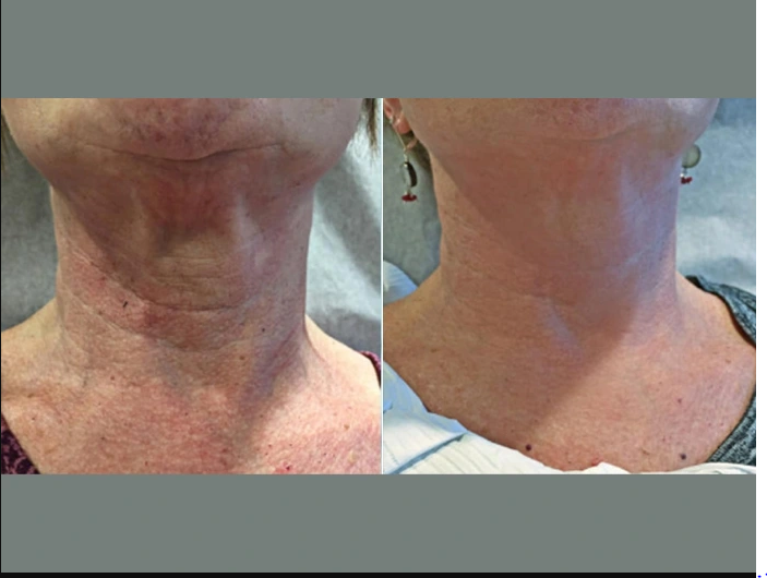 Skin Tightening Treatments in Dubai for Long-Term Skin Rejuvenation