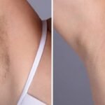 Laser hair removal in Dubai: Is It Safe for All Skin Types?