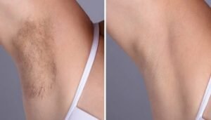 Laser hair removal in Dubai: Is It Safe for All Skin Types?
