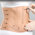 Abdominoplasty In Dubai: Reshape Your Abdomen For Better Definition