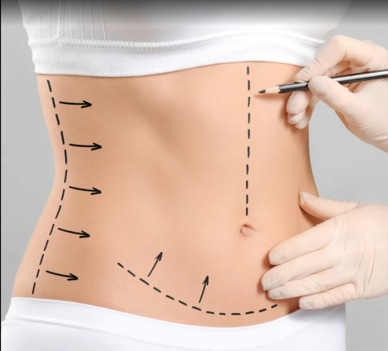 Abdominoplasty In Dubai: Reshape Your Abdomen For Better Definition