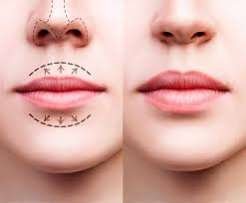 Natürliche Lippenvergrößerung: Mehr Ausdruck, ohne dass man es sieht