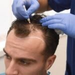 Hair Transplant in Dubai: Designing Grafts for Natural Growth