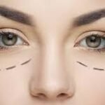 Upper Eyelid Surgery in London: How Are Individual Eyelid Shapes Considered During Planning?