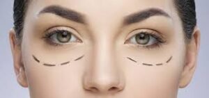 Upper Eyelid Surgery in London: How Are Individual Eyelid Shapes Considered During Planning?